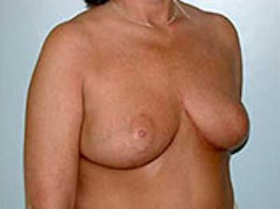 Breast Reduction Before & After Gallery - Patient 4594939 - Image 2