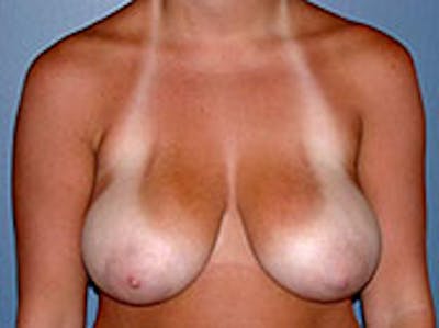 Breast Reduction Before & After Gallery - Patient 4594940 - Image 1