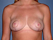 Breast Reduction