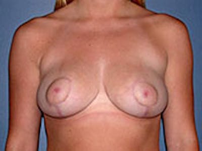 Breast Reduction Before & After Gallery - Patient 4594940 - Image 2