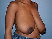 Breast Reduction