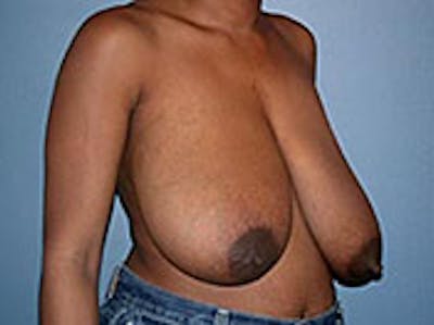 Breast Reduction Before & After Gallery - Patient 4594941 - Image 1
