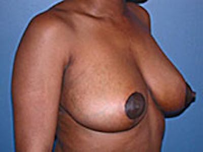 Breast Reduction Before & After Gallery - Patient 4594941 - Image 2