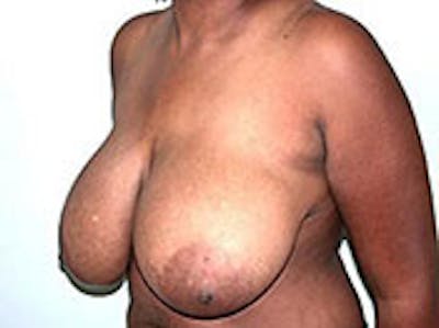 Breast Reduction Before & After Gallery - Patient 4594942 - Image 1