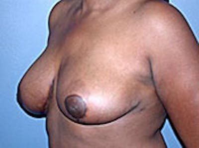 Breast Reduction Before & After Gallery - Patient 4594942 - Image 2