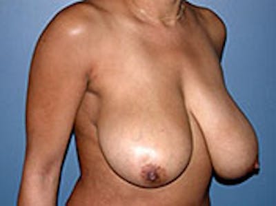 Breast Reduction Before & After Gallery - Patient 4594943 - Image 1