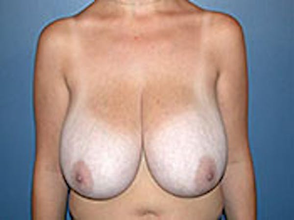 Breast Reduction Before & After Gallery - Patient 4594944 - Image 1