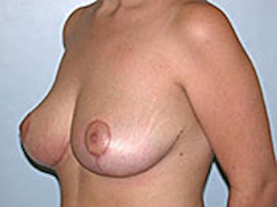 Breast Reduction Before & After Gallery - Patient 4594944 - Image 2