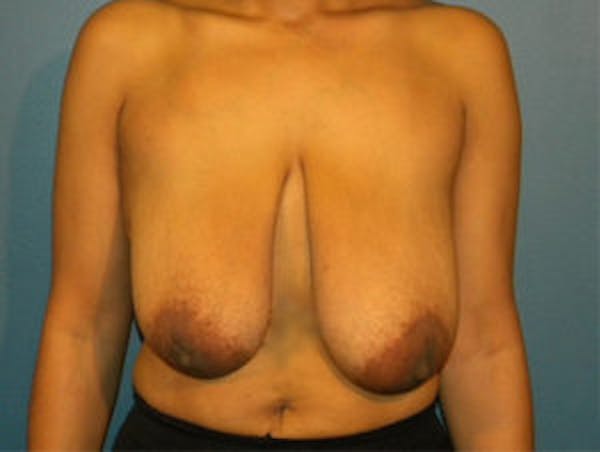 Breast Reduction Before & After Gallery - Patient 4594945 - Image 1