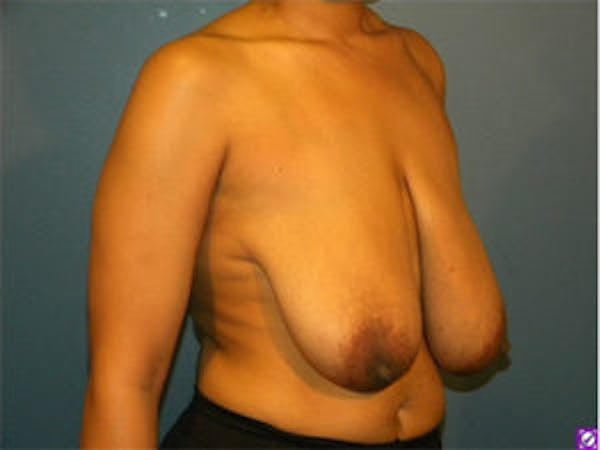 Breast Reduction Before & After Gallery - Patient 4594945 - Image 3