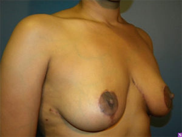 Breast Reduction Before & After Gallery - Patient 4594945 - Image 4