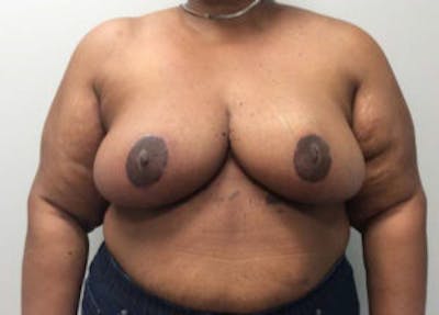Breast Reduction Before & After Gallery - Patient 4594947 - Image 2