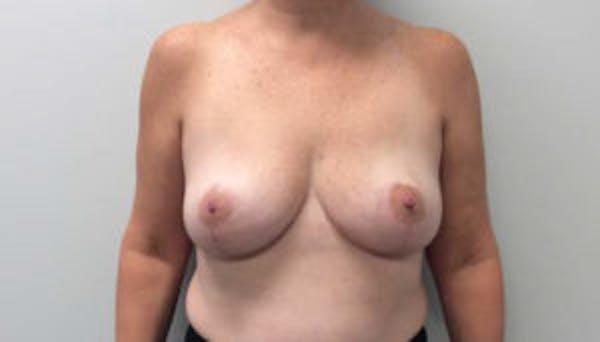 Breast Reduction Before & After Gallery - Patient 4594948 - Image 2