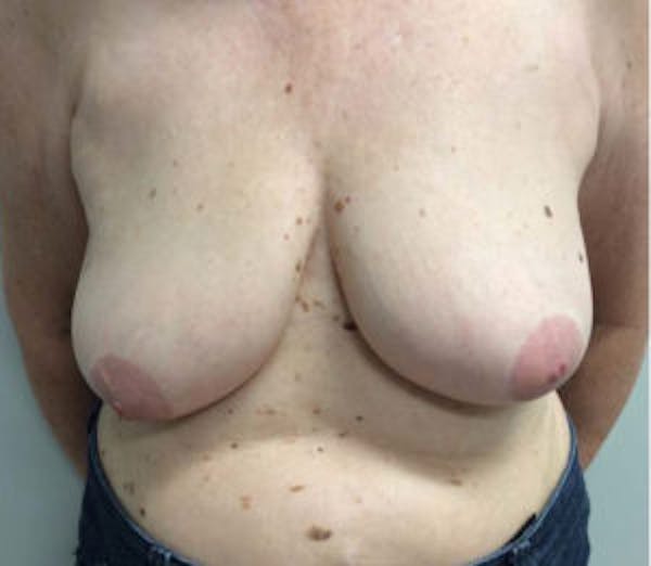 Breast Reduction Before & After Gallery - Patient 4594950 - Image 1