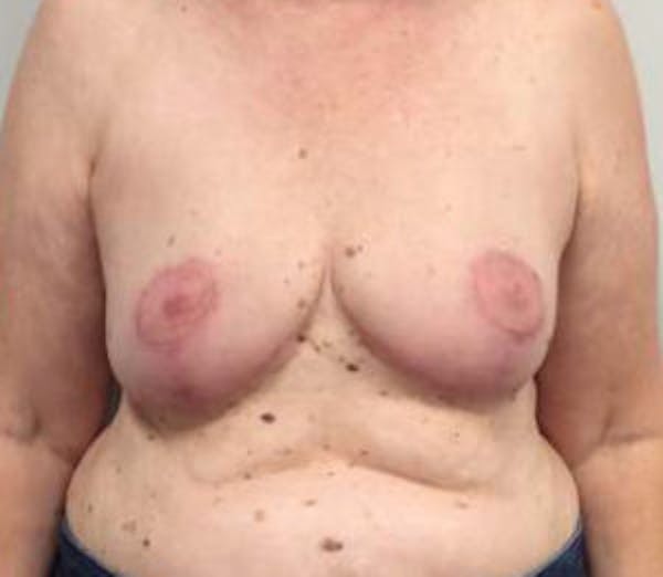 Breast Reduction Before & After Gallery - Patient 4594950 - Image 2