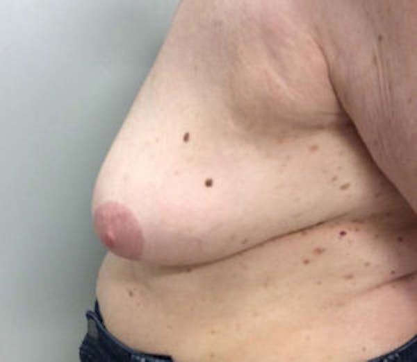 Breast Reduction Before & After Gallery - Patient 4594950 - Image 3