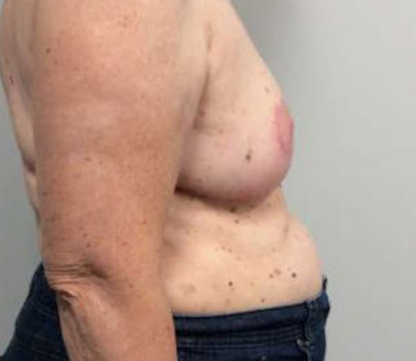 Breast Reduction Before & After Gallery - Patient 4594950 - Image 6