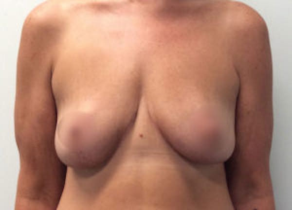 Breast Reduction Before & After Gallery - Patient 4594951 - Image 2