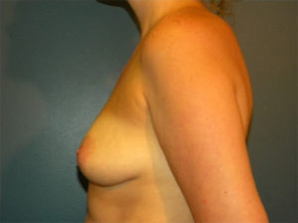 Mastopexy Before & After Gallery - Patient 4709862 - Image 3
