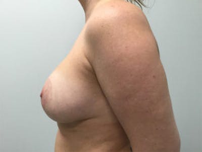 Mastopexy Before & After Gallery - Patient 4709862 - Image 4