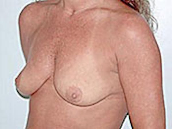 Mastopexy Before & After Gallery - Patient 4709864 - Image 1