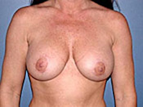 Mastopexy Before & After Gallery - Patient 4709864 - Image 2