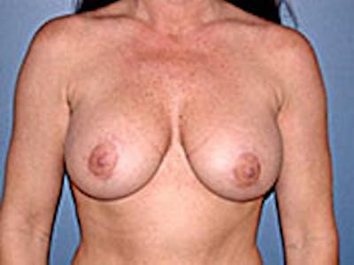 Mastopexy Before & After Gallery - Patient 4709864 - Image 2