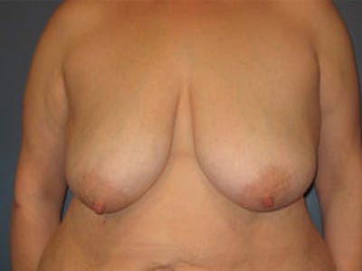 Mastopexy Before & After Gallery - Patient 4709865 - Image 1