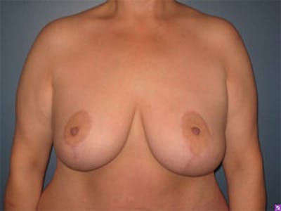 Mastopexy Before & After Gallery - Patient 4709865 - Image 2