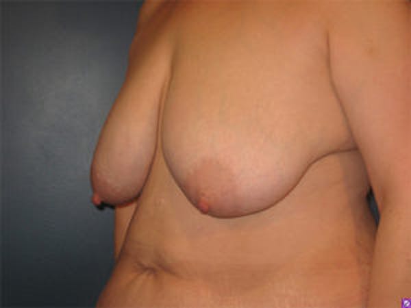Mastopexy Before & After Gallery - Patient 4709865 - Image 3