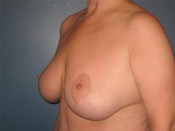 Mastopexy Before & After Gallery - Patient 4709865 - Image 4