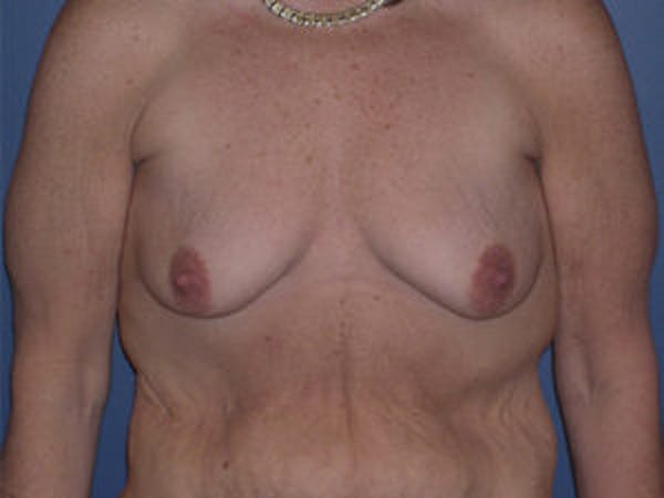 Mastopexy Before & After Gallery - Patient 4709866 - Image 1