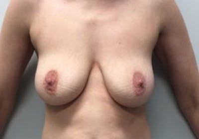 Mastopexy Before & After Gallery - Patient 4709868 - Image 1