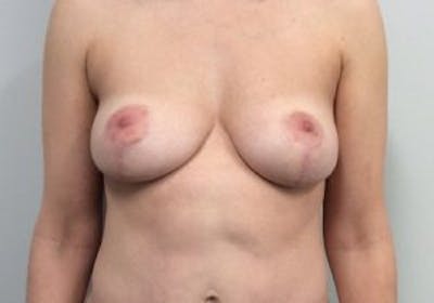 Mastopexy Before & After Gallery - Patient 4709868 - Image 2