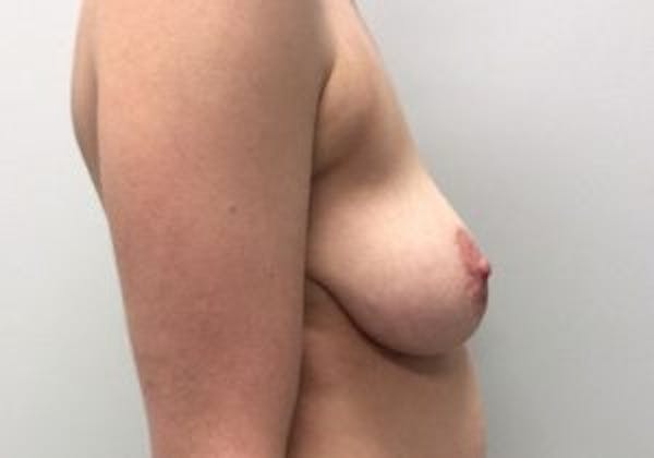 Mastopexy Before & After Gallery - Patient 4709868 - Image 3