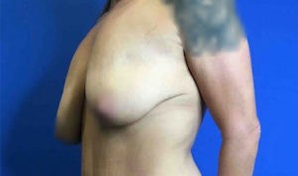 Mastopexy Before & After Gallery - Patient 4709869 - Image 3