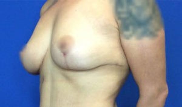 Mastopexy Before & After Gallery - Patient 4709869 - Image 4