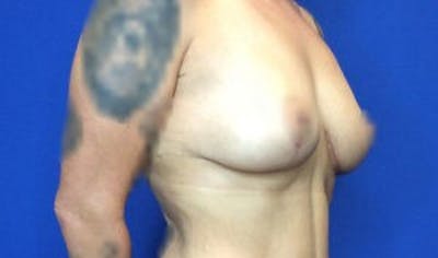 Mastopexy Before & After Gallery - Patient 4709869 - Image 6