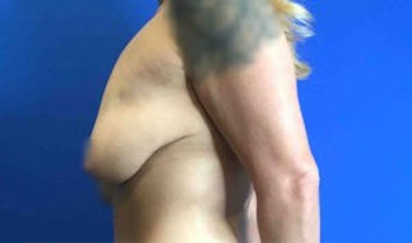 Mastopexy Before & After Gallery - Patient 4709869 - Image 7