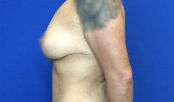 Mastopexy Before & After Gallery - Patient 4709869 - Image 8