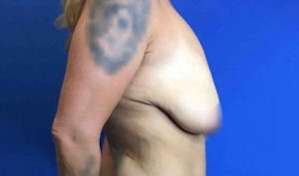 Mastopexy Before & After Gallery - Patient 4709869 - Image 9