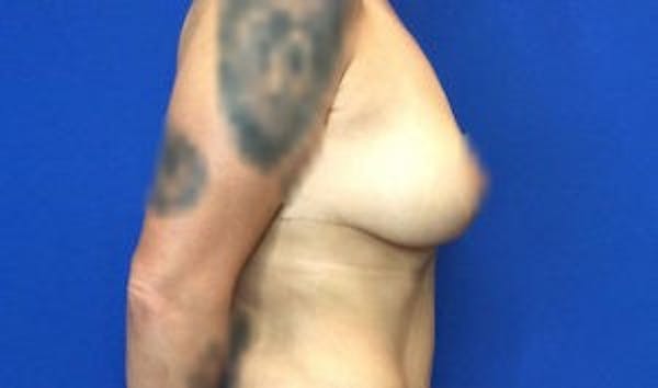 Mastopexy Before & After Gallery - Patient 4709869 - Image 10