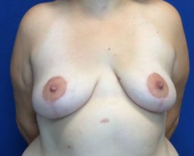 Mastopexy Before & After Gallery - Patient 4709870 - Image 2