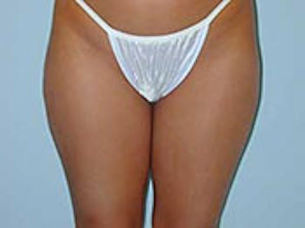 Liposuction Before & After Gallery - Patient 4726792 - Image 1