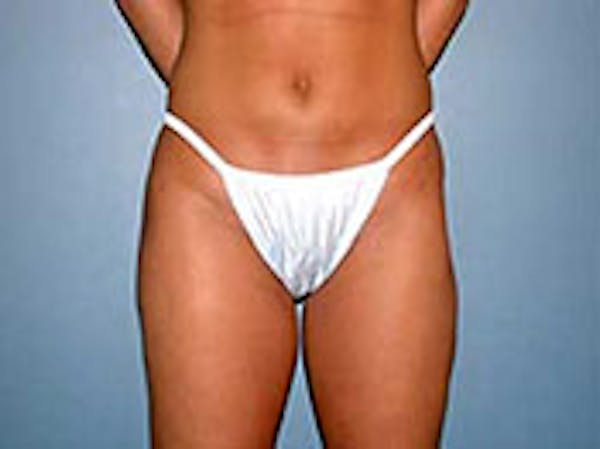 Liposuction Before & After Gallery - Patient 4726792 - Image 2