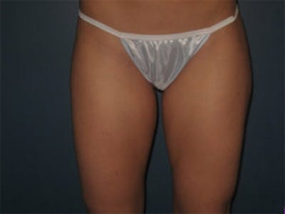 Liposuction Before & After Gallery - Patient 4726793 - Image 1