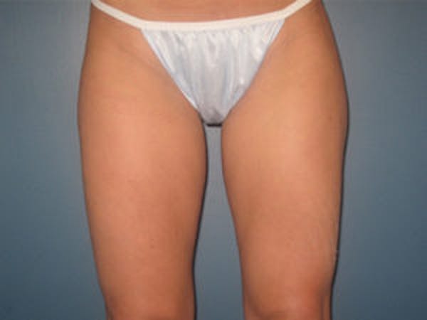 Liposuction Before & After Gallery - Patient 4726793 - Image 2