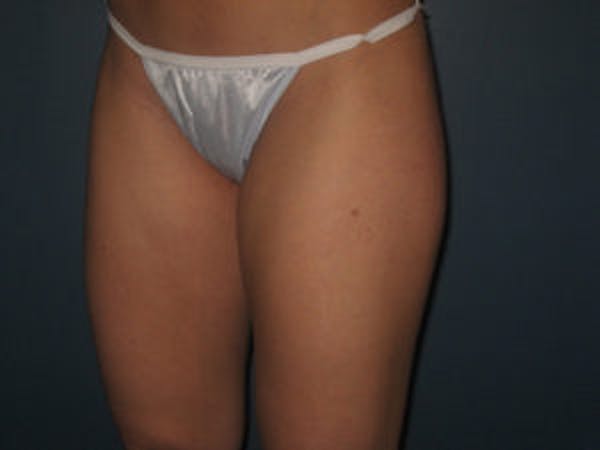Liposuction Before & After Gallery - Patient 4726793 - Image 3