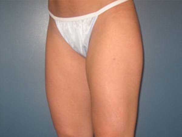 Liposuction Before & After Gallery - Patient 4726793 - Image 4