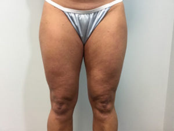 Liposuction Gallery - Patient 4726794 - Image 1